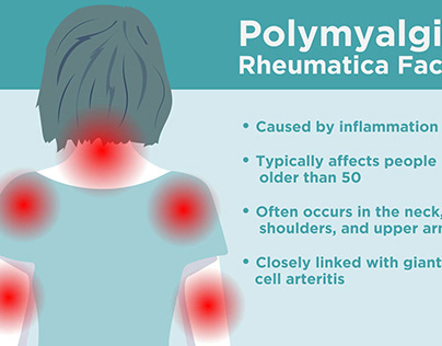 Polymyalgia Rheumatica Disease: Diagnostic Challenges