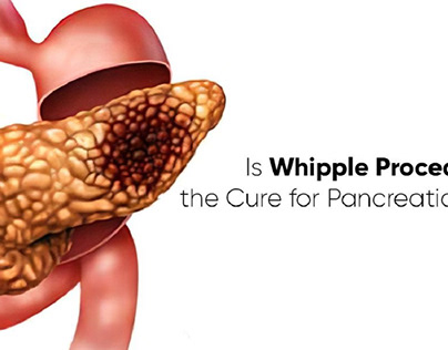 IS WHIPPLE PROCEDURE THE CURE FOR PANCREATIC CANCER?