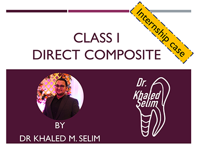 (INTERNSHIP) Class I direct composite lower molar