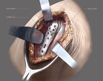 Surgical Illustration, Proximal Humeral Fracture Repair