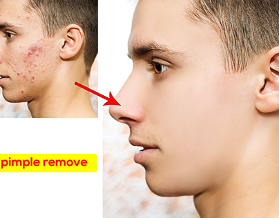 Male Pimple Remove