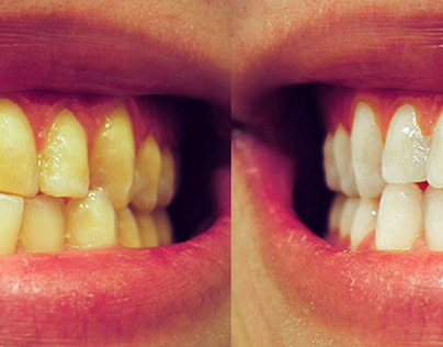 Yellow to white teeth