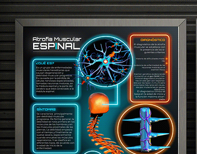 Infografía Atrofia Muscular Espinal