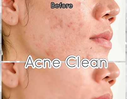 Acne Clean Using Adobe Photoshop