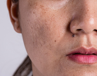 How to Choose the Right Dermal Pigmentation Treatment