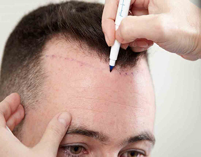Eligibility of A Good Candidate For Hair Transplant