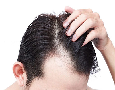 Advantages Associated With Hair Transplant Procedure