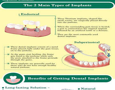 Dental Implants – Types and Benefits