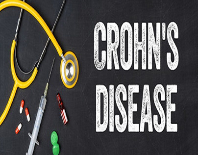 Crohn's Disease - Symptoms and Complications