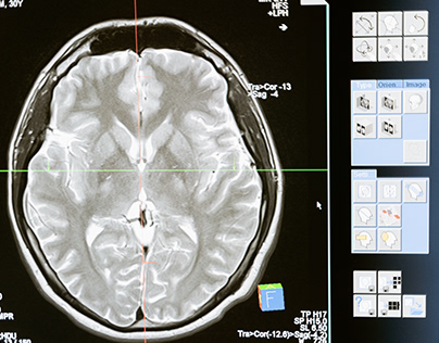 A Brief Look at Stereotactic Radiosurgery for the Brain