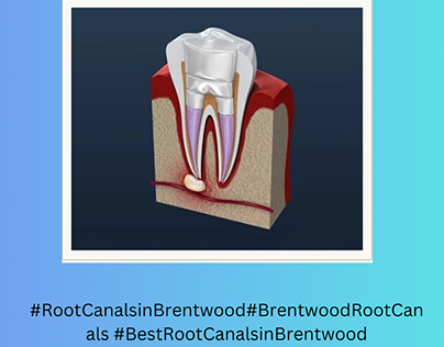 Root Canals in Brentwood