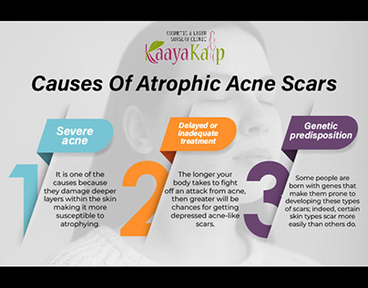 Causes Of Atrophic Acne Scars
