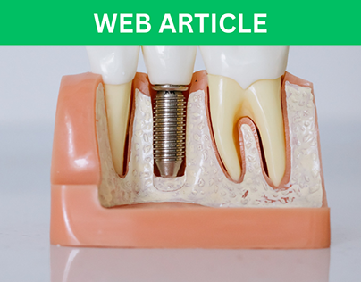 Web Article: Sinus Lift & Dental Implants