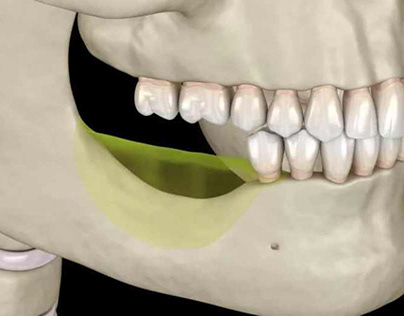 Trồng răng khi bị tiêu xương hàm được không?
