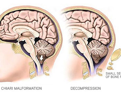 Neurological Disorders - Chiari Malformations