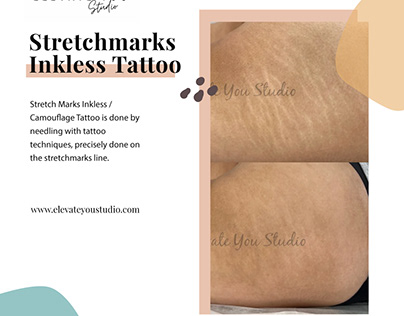 Stretchmarks Inkless Tattoo ( Inkless revision)