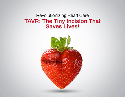 TAVR: The Tiny Incision That Saves Lives!