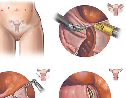 Davinci Hysterectomy
