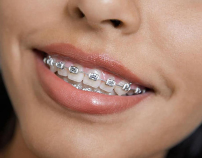 How to Maximize the Benefits of Orthodontic Treatment?