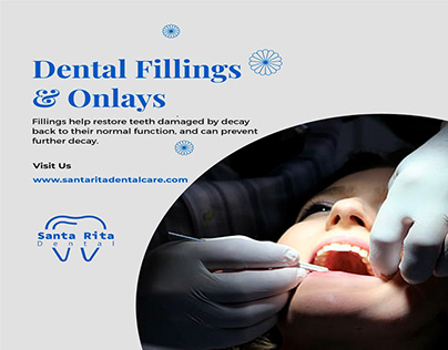 Dental Fillings & Onlays