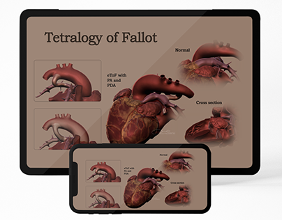 Tetralogy of Fallot - Medical Sculpture