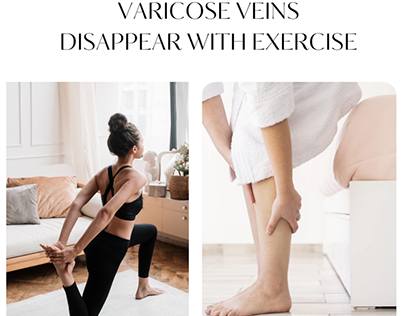 varicose veins disappear with exercise