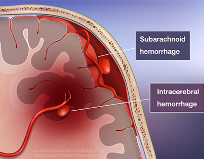 Subarachnoid and Intracerebral hemorrhage
