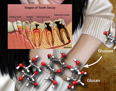 Tooth Decay Poster