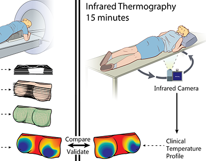 Comparing MRI and Infrared Camerafor Breast Cancer
