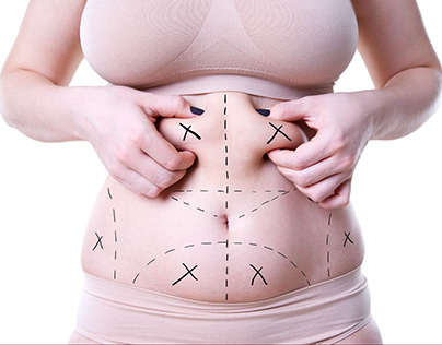 How Much Liposuction Surgery Cost in India