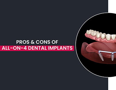 Pros and Cons of All on 4 Dental Implants