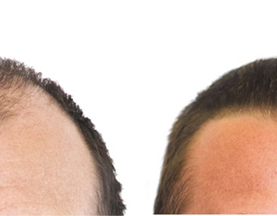 Synthetic Hair Transplant in Bangalore