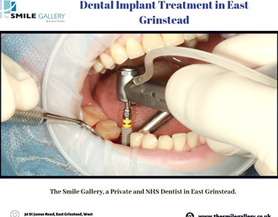 Dental Implant Treatment in East Grinstead