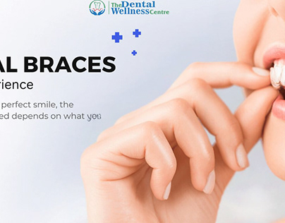 Affordable Dental Braces Cost in Ahmedabad
