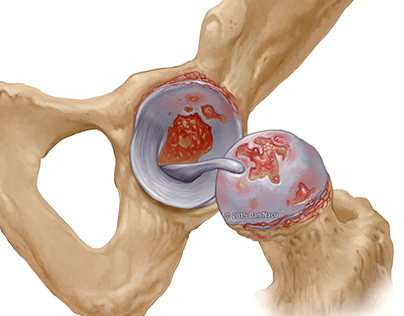 Osteoarthritis Detail of Injury