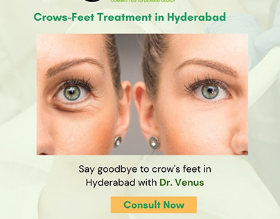 Crows-Feet Treatment in Hyderabad | Dr. Venus