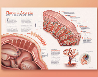 Placenta Accreta Spectrum Disorders