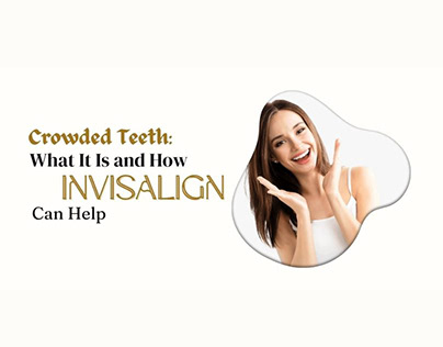 Crowded Teeth_ What It Is and How Invisalign Can Help