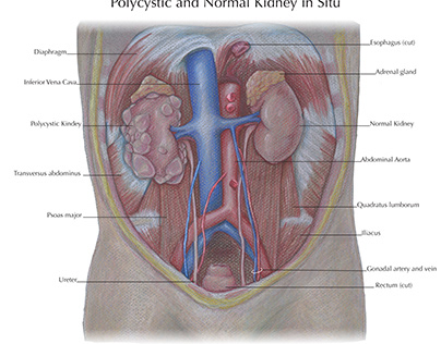 Polycystic and Normal Kidney in Situ