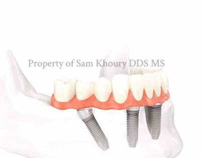 dental implants Bucks County PA