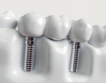 Dental Implants Worcester