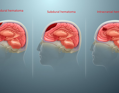 Subdural Hematomas : Symptoms Causes Risks