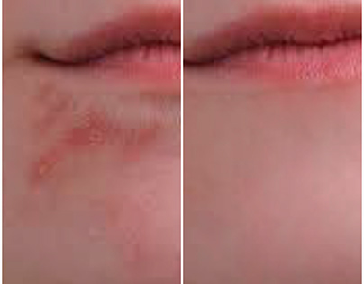 Mouth Infection Skin Cleanup with Photoshop