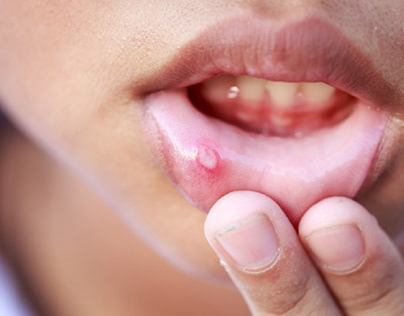 How Dentists Can Treat Canker and Cold Sores