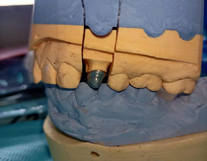 fixed prosthodontics