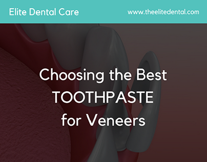 Choosing the Best Toothpaste for Veneers