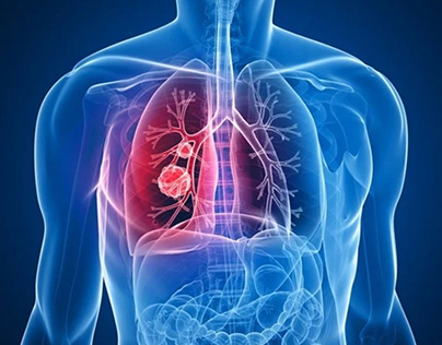 DOES FAMILY HISTORY HEIGHTEN LUNG CANCER RISK?