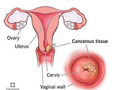 Promotion video on cervical cancer