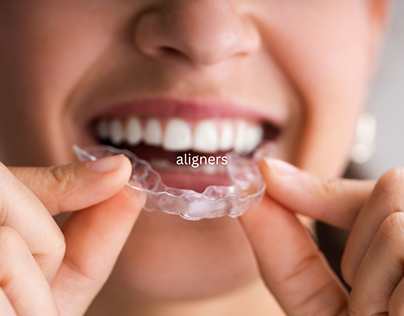 How and When to Wear Aligners