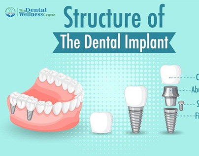 Dr.vishal patel – Best Dental Implants in Ahmedabad